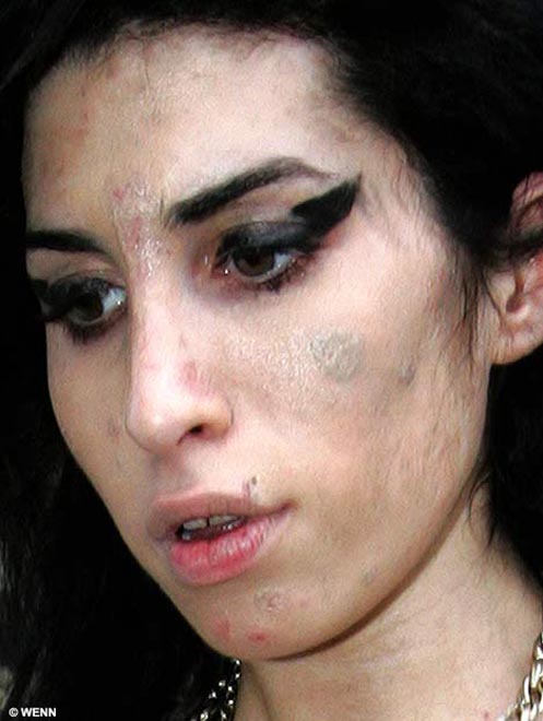 Amy Winehouse buys a sunbed - but will it be enough to cure her scabby face?