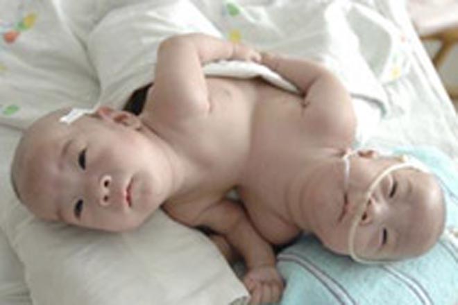 Ex-conjoined twins leave hospital on birthday eve